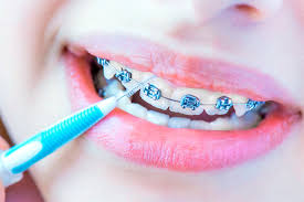 Como Lavarse Correctamente Los Dientes Con Brackets Clinica Dental Vigo Riosdent