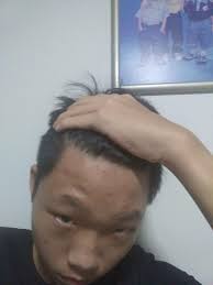 Hair loss at any age can be devastating, but to begin the hair loss process as a teenager is beyond the scope of what most teens will ever be forced to cope with. Im 14 Is My Hairline Receding Thanks Hairloss