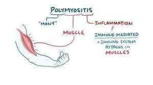 Image result for Polymyositis