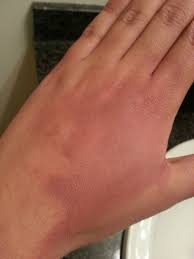 Check spelling or type a new query. Second Degree Burn Healing Progression Album On Imgur