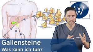 If you have them, you might hear your doctor say you have cholelithiasis. Gallensteine Was Nun Typische Symptome Alles Zur Entstehung Tipps Zur Naturlichen Entfernung Youtube