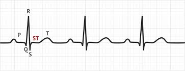 Image result for ST Segment