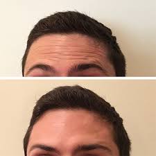 Es importante que la aplicación sea absolutamente estéril. Toxina Botulinica Botox Usos Y Propiedades Medicina Estetica Barcelona