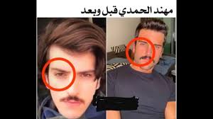 نشر الممثل السعودي مهند الحمدي صورة له مع حبيبته وهما يرتديان خاتميّ الخطوبة معلناً ارتباطه رسمياً بها وعلق كاتباً : Ø´Ø§Ù‡Ø¯ Ù…Ù‡Ù†Ø¯ Ø§Ù„Ø­Ù…Ø¯ÙŠ Ù‚Ø¨Ù„ ÙˆØ¨Ø¹Ø¯ Ø¹Ù…Ù„ÙŠØ§Øª Ø§Ù„ØªØ¬Ù…ÙŠÙ„ Ø¹Ù„Ù‰ Ø§Ù†Ø³ØªÙ‚Ø±Ø§Ù… ÙˆÙƒØ§Ù„Ø© Ø®Ø¨Ø± Ø§Ù„ÙÙ„Ø³Ø·ÙŠÙ†ÙŠØ© Ù„Ù„ØµØ­Ø§ÙØ©