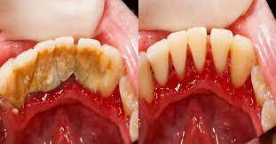 Quelles sont les causes de ces dépôts disgracieux sur les dents ? Astuce Maison Pour Enlever Le Tartre Dentaire Soi Meme