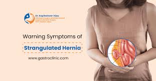 Image result for stomach hernia symptoms