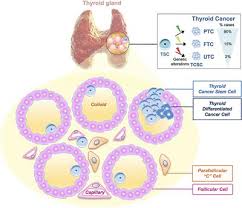Desiccated thyroid is given when the thyroid does not produce enough of this hormone on its own. Frontiers Cancer Stem Cells In Thyroid Tumors From The Origin To Metastasis Endocrinology