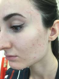 Mirena is less maintenance and can completely stop your period. 3 Months Post Mirena Coil My Skin Makes Me Feel Disgusting Please Help Acne