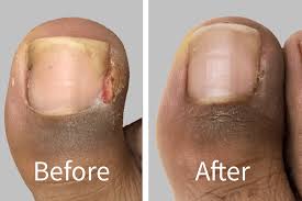 Image result for Toenail Removal