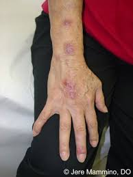 This fungal disease usually affects the skin, although other rare forms can affect the lungs, joints, bones, and even the brain. Sporotrichosis American Osteopathic College Of Dermatology Aocd