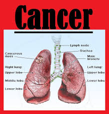 There is currently no cure, but certain treatments can prolong life. Lung Cancer Stage 4 Lung Cancer Kimaja Farwani