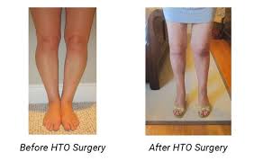 Pin On Bowed Legs Solution Without Surgery