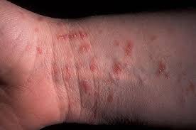 Image result for scabies bite