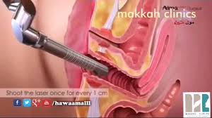 makkah clinics عمليات الليزر لتضيق وشد المهبل facebook