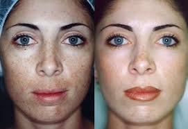 Pin On Chemical Peels Before And After Pics