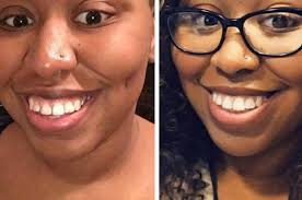 But how long must you wear a retainer? This Company Is Trying To Disrupt The Braces Industry And Dentists Are Fighting Back