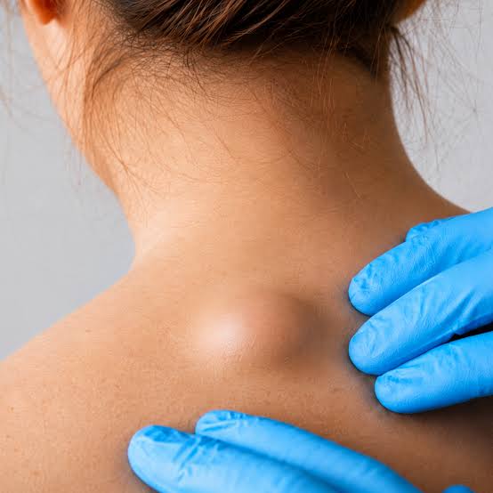 Lipoma Removal Melbourne CBD | Skin Surgery Clinic