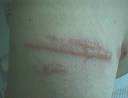 Image result for Photodermatitis