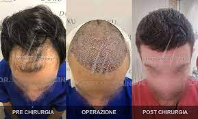 È fondamentale evitare qualsiasi attività sessuale durante i primi 2 giorni post intervento. Dr Serkan Aygin Trapianto Capelli Turchia