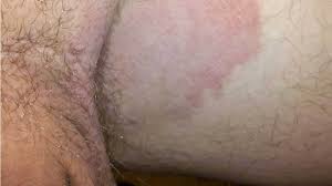 Picazon Imagenes Causas Diagnostico Remedios Caseros Y Mas