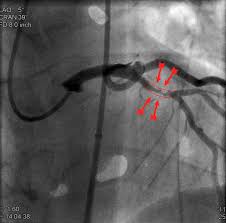 Heart attack survivor tells all, gives advice | Article | The United States  Army