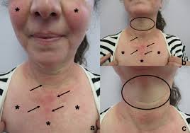 Image result for Photodermatitis