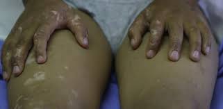 Penyakit Kulit Vitiligo: Sehat dari Dalam, Cantik dari Luar