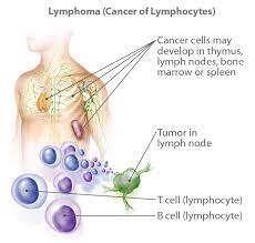 Lymphomas are cancers of lymphocytes. What Is Lymphoma Signs Symptoms Types Stages Ctca
