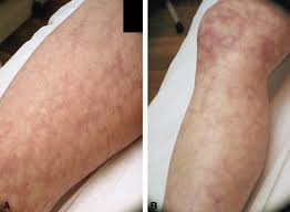 Since some clients may feel discomfort when the skin is exposed to the light pulse from the ipl device and/or the laser device from the alexandrite, topical anesthetic creams are. References In Reticulate Erythema Following Diode Laser Assisted Hair Removal A New Side Effect Of A Common Procedure Journal Of The American Academy Of Dermatology