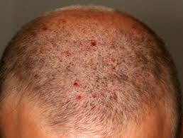 Scalp folliculitis | DermNet