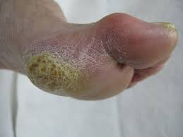 Image result for Koilonychia feet