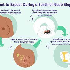 Cancer which has spread to distant lymph nodes from the primary cancer site will likely need additional treatment other than surgery, such as chemotherapy and radiation. Lymph Node Positive Breast Cancer Symptoms And Treatment