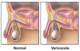 Instances of testicular cancer are especially. Varicocele And Infertility Is There A Link