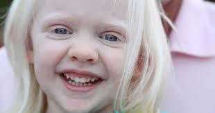 5 Fakta Penyakit Albino Yang Mama Harus Tahu Popmama Com
