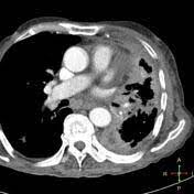 Receive a free book on pleural mesothelioma causes, symptoms, treatments & more. Mesothelioma Radiology Reference Article Radiopaedia Org