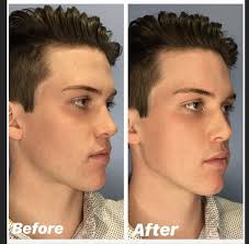 We See A Lot Of Requests To Enhance The Shape Of The Jawline For Men We They Often Want A More Defined Angular Jaw F Perfect Jawline Jawline Chiseled Jawline