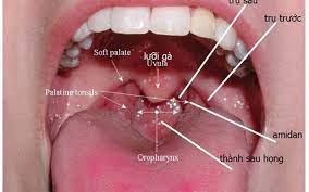 Việc phát hiện tình trạng tăng sinh mạch máu là các dấu hiệu sớm nhất trong trường hợp ung thư vòm mũi họng, khi mà khối u còn khu trú. Hinh áº£nh Ä'áº§y Ä'á»§ Nháº¥t Vá» Bá»‡nh Ung ThÆ° Vom Há»ng Antican Vn