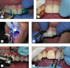 Check spelling or type a new query. Bonded Cementation Of Veneers And Onlays Pocket Dentistry