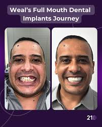 Ellen's new smile is absolutely radiant! 😁 From her initial consultation  to her final smile, every step was guided with care and precision. With her  new smile, Ellen's confidence has been completely