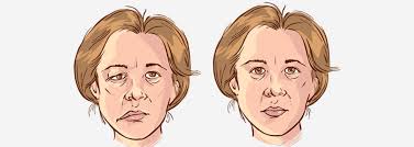 Unilateral Facial Paralysis Bell S Palsy Facial Nerve Bells Palsy Facial Muscles