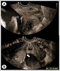 It was i believe the only one in london. Guideline No 402 Diagnosis And Management Of Placenta Previa Journal Of Obstetrics And Gynaecology Canada