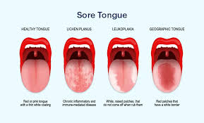 Image result for brown tongue symptoms