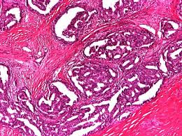 Tipul de tratament recomandat depinde de marimea si de localizarea tumorii sanului, de rezultatele testelor de laborator, de stadiul sau. Https Www Hilarispublisher Com Open Access Particularities Of Primary Breast Cancer In Men 1584 9341 12 1 8 Pdf