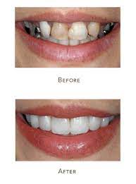 Composite veneers cost between £200 to £500 per tooth. Dental Veneers Houston Porcelain Veneers Cost Memorial Houston Tx