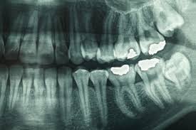 How Safe Are Dental X Rays What S Involved And Why They Re Performed