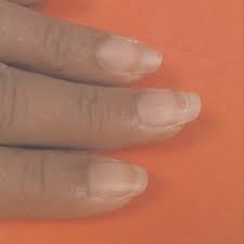 It can be confused with unilateral. Lindsay Nails Half And Half Nails Download Scientific Diagram