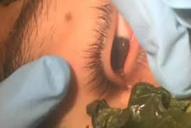 Sebenarnya ulat resdung yang dikatakan keluar dari muka ketika rawatan bukan lah ulat.resdung tetapi ulatyang keluar daripada lipas itu sendiri ! Pakai Kemangi Dokter Berhasil Keluarkan Ulat Dari Mata Remaja Ini