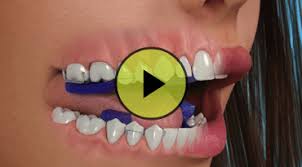 Foods that you need to bite into forcefully such as apples, raw carrots and corn. Functional Appliances Surrey Orthodontics Limited