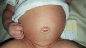 Keep the belly button area clean and dry. Newborn Baby Umbilical Cord After It Falls Off Newborn Baby