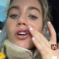 TikTok star Olivia Neill 'reinventing herself' after getting lip filler  dissolved